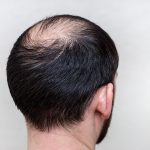 Kondisi Kebotakan Kepala Pada Rambut Seseorang