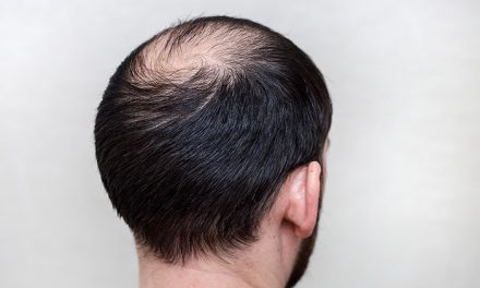Kondisi Kebotakan Kepala Pada Rambut Seseorang