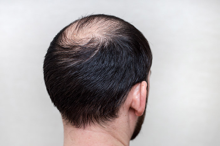 Kondisi Kebotakan Kepala Pada Rambut Seseorang
